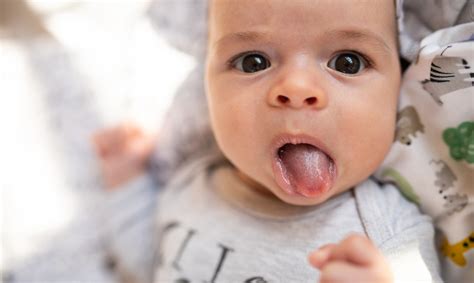 Breastfeeding Newborn Thrush Vs Milk Tongue at Gail Key blog
