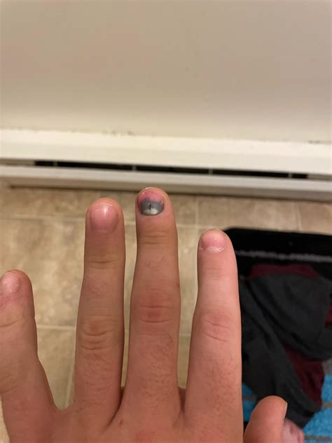Smashed Finger Treatment
