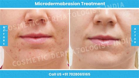 Microdermabrasion Treatment Cost in Mumbai, India | Cosmetic ...