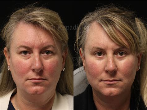 Before and 6 months after upper and lower blepharoplasty surgery with lower lid CO2 laser ...