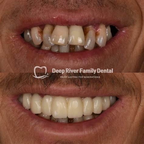 Smile Transformations | Deep River Family Dental
