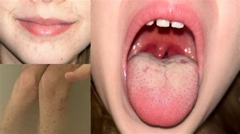 Strep Rash Scarlet Fever
