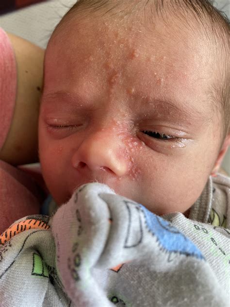 Newborn White Pimples Baby Acne: Causes, Symptoms, And Treatment