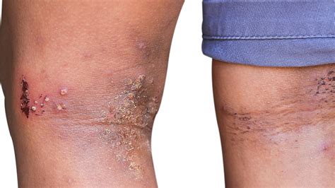 Is Eczema Contagious To Others at Elaine Hudson blog