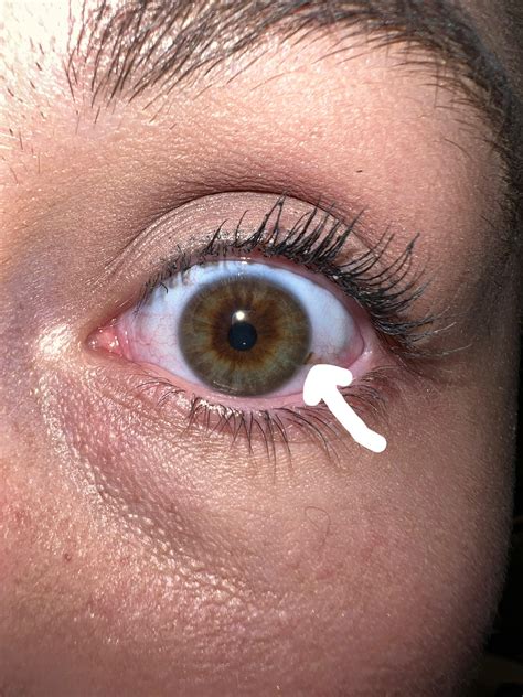 Eye freckle or ocular melanoma? : r/eyes