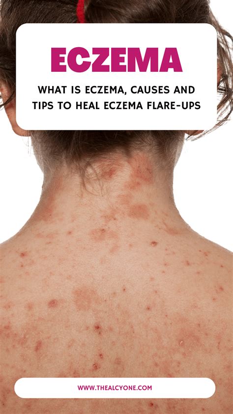 10 Tips To Heal Eczema Flare-Ups - The Alcyone