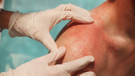 Can Drugs Cause Rashes at Laura Shann blog