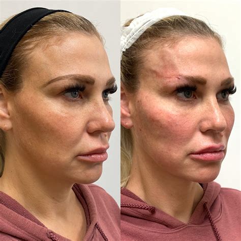 Pdo Threads Before And After Nose at Kathleen States blog