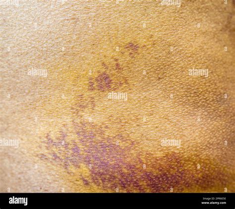 Running Injury Left Buttock at Maria Adkins blog