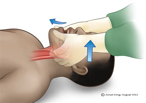 Jaw-Thrust Maneuver - Bachtiar Official