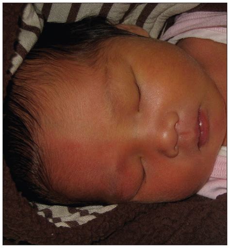 Harlequin colour change: unilateral erythema in a newborn | CMAJ