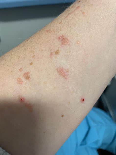 Dry, red, itchy bumps appeared in healed scars : r/DermatologyQuestions