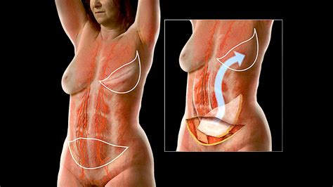 Mastectomy And Reconstructive Surgery The Reverse LICAP Flap: A