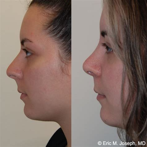 Eric M. Joseph, MD | Rhinoplasty Before & After: Corrected Nasal Flaring
