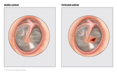 Paracentesis Ear