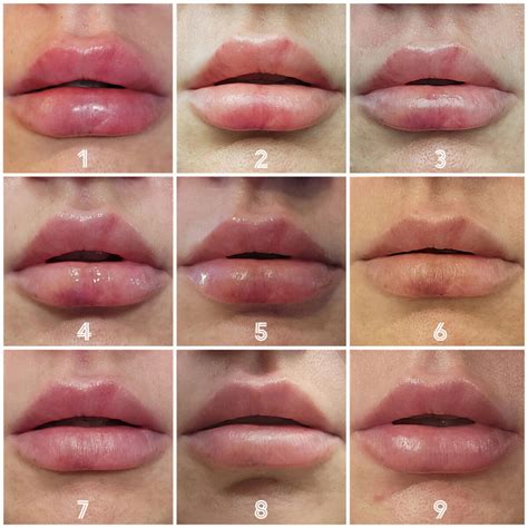 Lip Filler Swelling Timeline: How Long Will It Last?