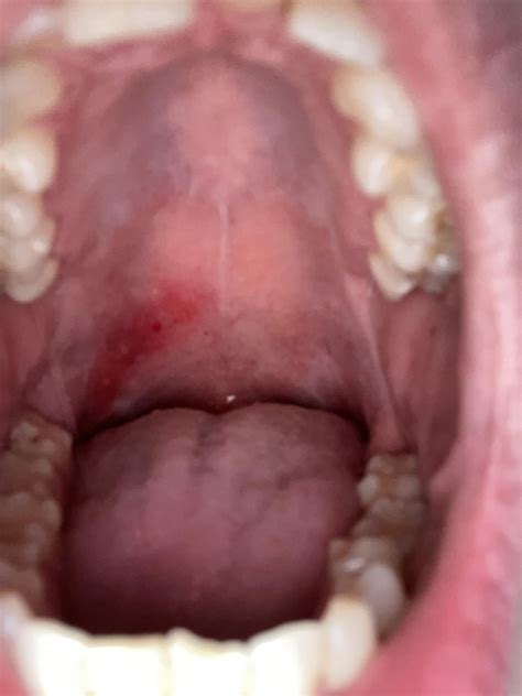 Sores on roof of mouth and gum : r/askdentists