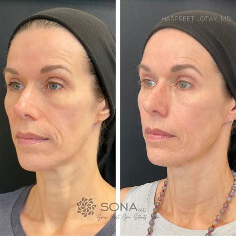 Sculptra® | SONA MD - Botox, Dermal Fillers Kamloops
