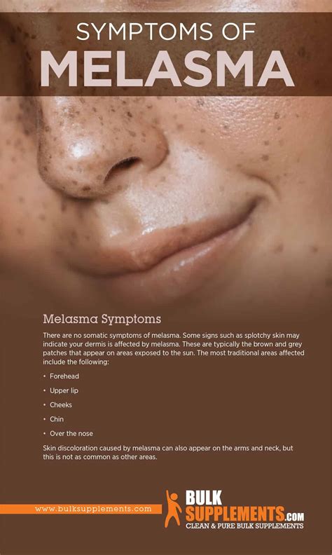 Melasma: Symptoms, Causes & Treatment