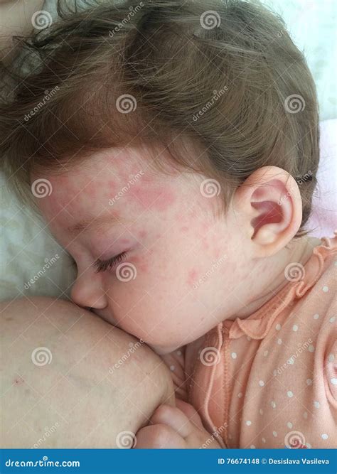 Roseola infantum stock photo. Image of hhv6, spot, rubella - 76674148