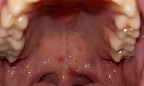 Red Spots on Roof of Mouth : r/medical
