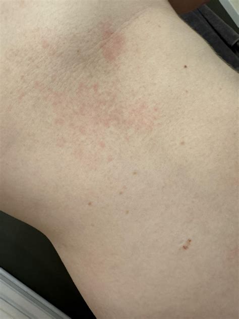 Rash while tanning in stand up bed?? : r/tanning