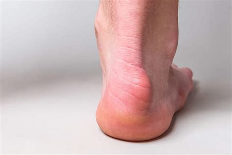 Haglund's Deformity | Heel Bump | Family Foot Care & Surgery