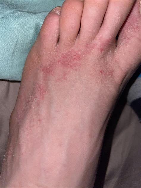 Whats that red rash on my foot ? : r/medical