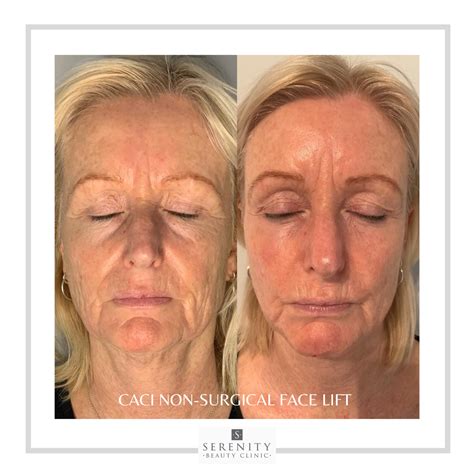 Non-Surgical Facial Lift - Serenity Beauty Clinic in Staffordshire