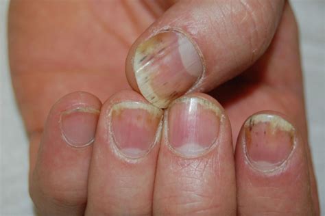 Nail Psoriasis Telltale Signs Of Nail Psoriasis And When The Poor