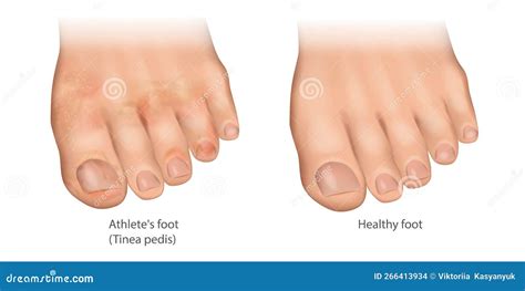 Can A 2 Year Old Have Athlete's Foot at Violet Charette blog