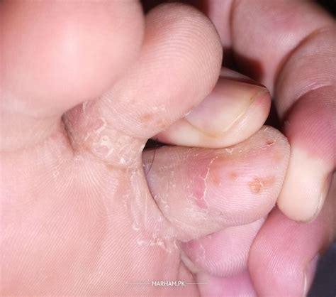 Ask a Dermatologist Online for Red Spots, Brown Bumps, Peeling Skin Betwee