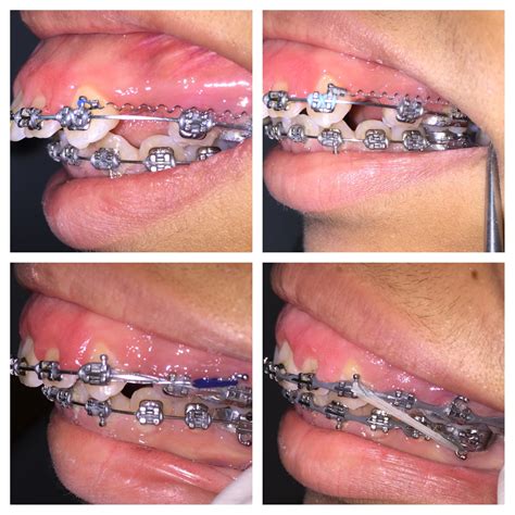 Overbite Correction Braces