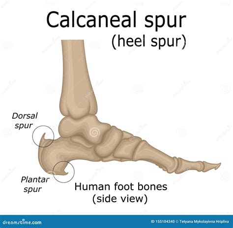 Illustration of Calcaneal Spur Stock Vector - Illustration of bone ...