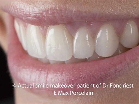 Composite Bridge Dental at Christian Brown blog