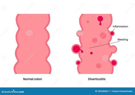 Diverticulitis And Diverticulosis Cartoon Vector | CartoonDealer.com ...