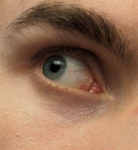 Lacrimal Caruncle Inflamed