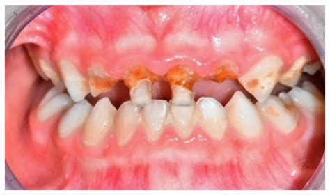 Damage from Carbonated Soft Drinks on Enamel: A Systematic Review