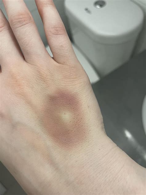 Weird bruising pattern on hand post iv : r/AskDoctorSmeeee