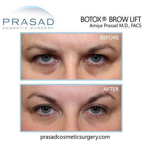 Brow Lift Before and After Photos | Manhattan and Long Island NY