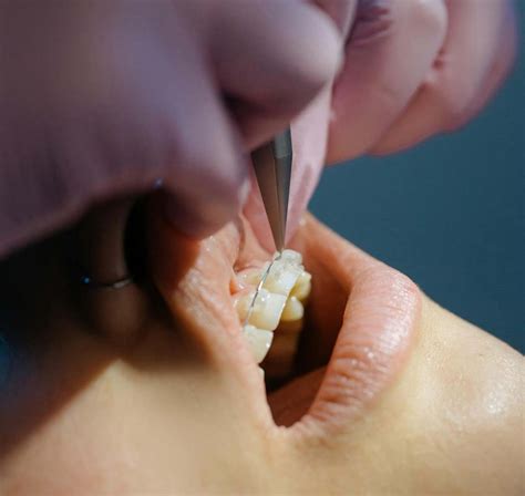 Abscessed Tooth Stages: Progression, Symptoms, and Care