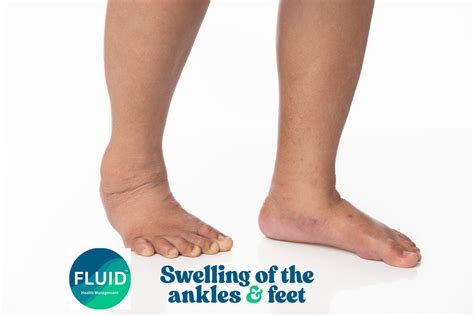 Swollen Ankles After Flying