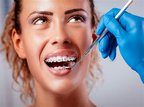 How Do Braces Work To Straighten Your Teeth? - Aransas