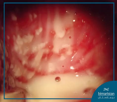 Vaginitis Treatment for Married women - Bimaristan