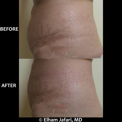Albums 105+ Pictures Before And After Laser Stretch Mark Removal Photos ...