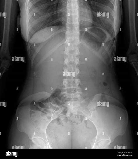Normal abdomen, X-ray Stock Photo - Alamy