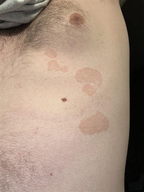 I, 22 (m) have had these red spots on my chest that have grown larger and spread over the course ...