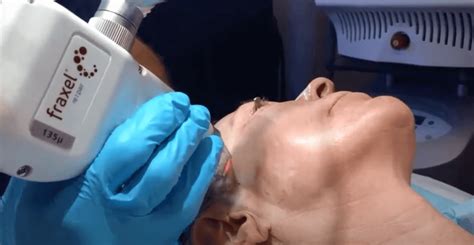 5 Best Procedures to Tighten Loose Skin Without Surgery - Laser NY