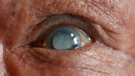 Toric Lenses: Revolutionising Cataract Surgery in London