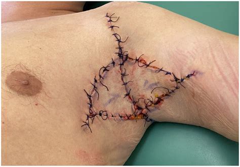 Surgical Treatment of Axillary Hidradenitis Suppurativa Using Preliminary Defect Closure and Two ...